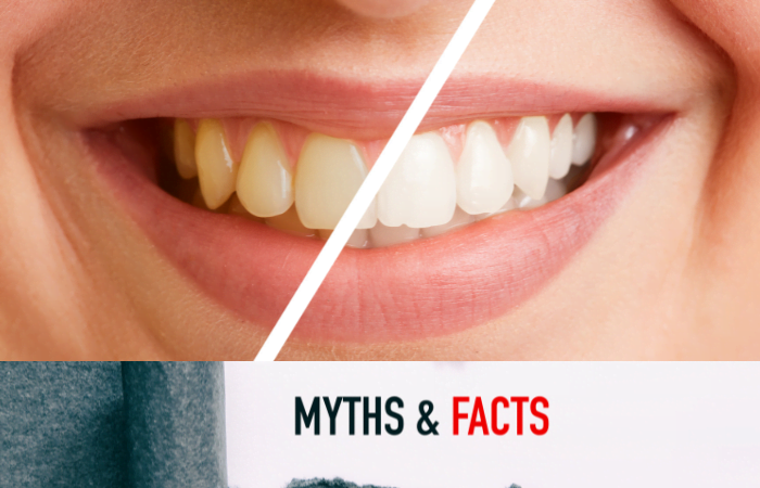 Tooth Cleaning Myths vs Facts